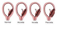 Image result for placenta accreta + picture